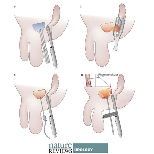 Focal Therapy Inline