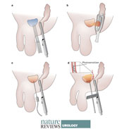 A Focus on Focal Therapies