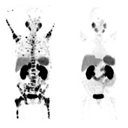 Theranostics for Prostate Cancer