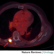 Oligometastatic Prostate Cancer: what is it and how is it best treated?