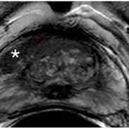 The MRI-FIRST study demonstrates the benefit of combined biopsy techniques