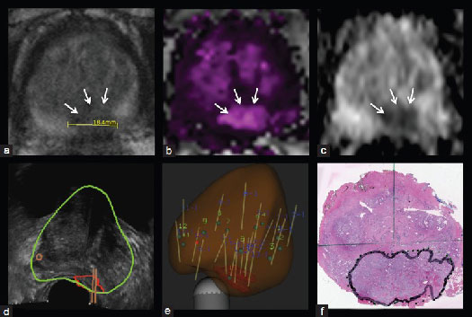 Systematic Prostate Biopsy Full