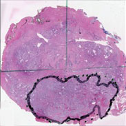 Should we do away with the systematic prostate biopsy?