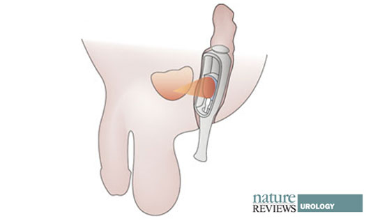 Salvage-HIFU is a feasible treatment for local prostate cancer recurrence after radiotherapy