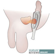 Salvage-HIFU is a feasible treatment for local prostate cancer recurrence after radiotherapy