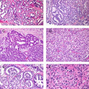 Does the new grading system for prostate cancer work for Australian men?