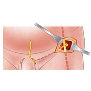 Promising early results for a new surgical technique to restore sexual function after prostate surgery