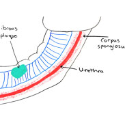 Peyronie’s disease in men with prostate cancer