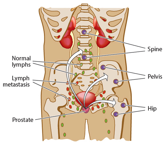 Australian researchers develop a tumour growth method to test new drugs for prostate cancer