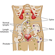 New treatments for men with non-metastatic castration resistant prostate cancer