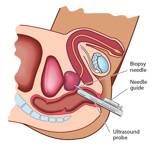 Can a biopsy spread prostate cancer?