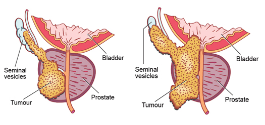 Locally advanced prostate cancer