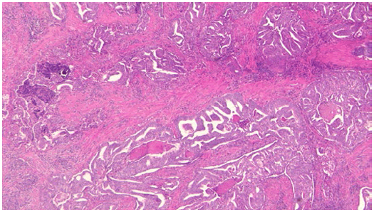 Ductal prostate cancer: a rare form of prostate cancer