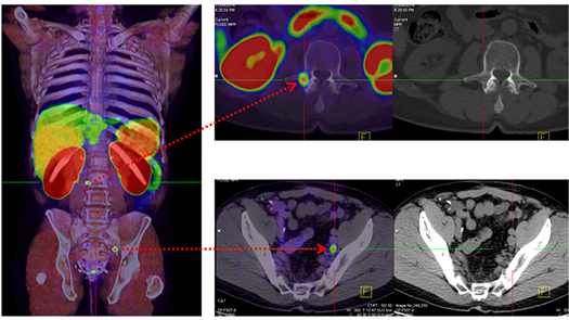 Which scans are best for men with recurrent prostate cancer?