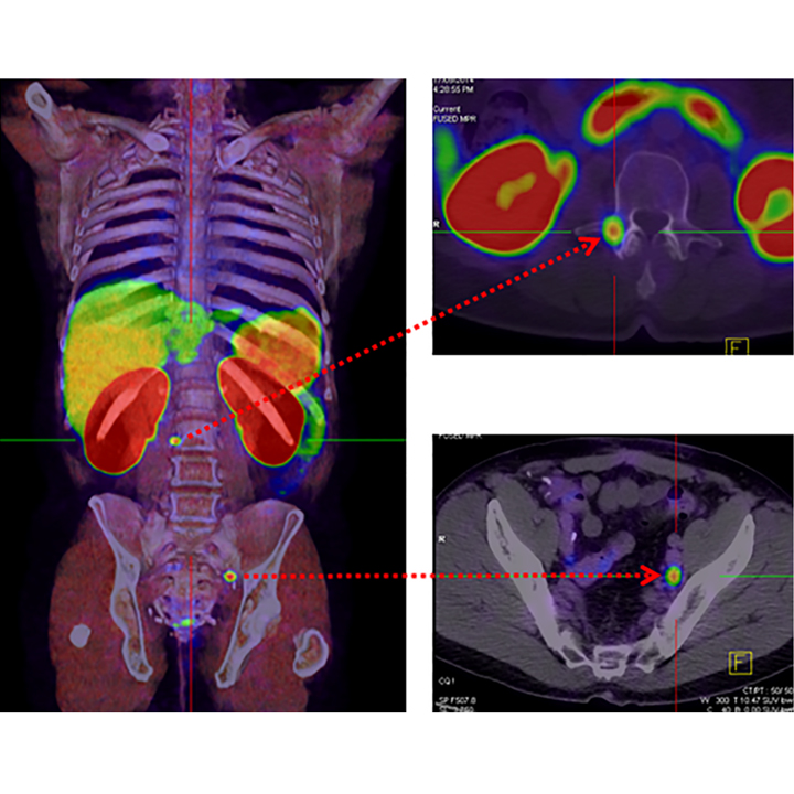 Which scans are best for men with recurrent prostate cancer?