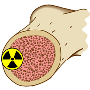 Combining radium-223 (Xofigo) with Abiraterone (Zytiga) is not recommended