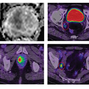 World leading Prostate Theranostics and Imaging Centre of Excellence (ProsTIC) opens in Australia