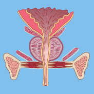 Bladder Neck Contracture